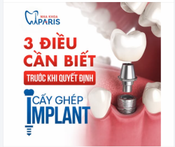 3 ĐIỀU CẦN BIẾT TRƯỚC KHI TRỒNG RĂNG IMPLANT
