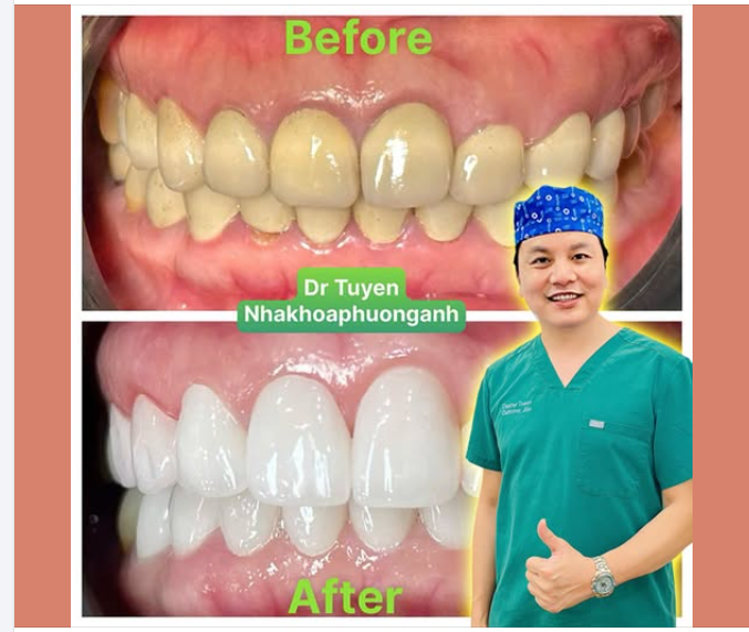 Bọc răng sứ lợi hại ra sao?
