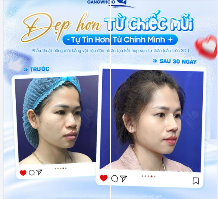 ĐẸP HƠN TỪ CHIẾC MŨI - TỰ TIN HƠN TỪ CHÍNH MÌNH