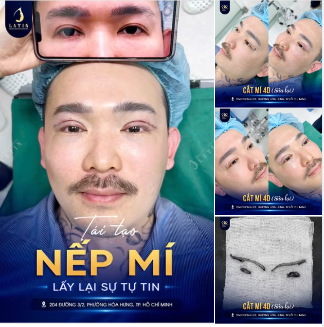 Sửa mí không phải tạo nên một nếp mí hoàn toàn khác, mà là chỉnh lại để nếp mí đẹp hơn và đúng ý hơn.