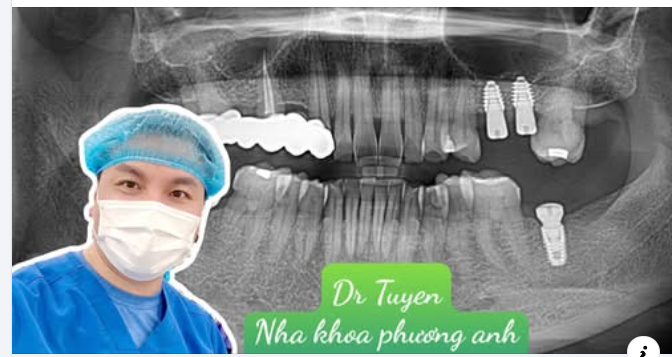 Sau khi cấy ghép implant cần kiêng gì?