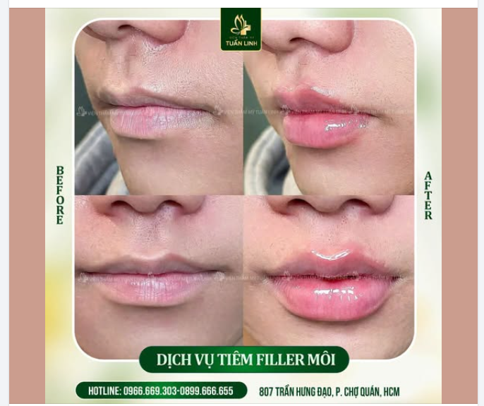 TIÊM FILLER MÔI – CHẠM NHẸ LÀ XINH, TỰ NHIÊN, GỢI CẢM