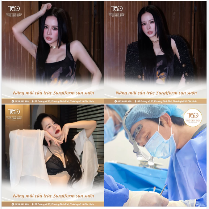Mũi sửa lại lần thứ 2 và những LƯU Ý quan trọng để đạt kết quả mỹ mãn