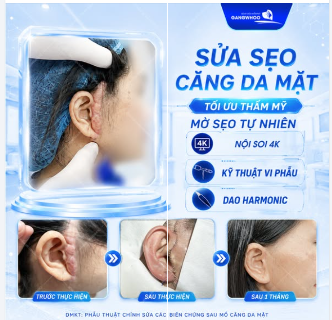 SỬA SẸO CĂNG DA MẶT - TỐI ƯU THẨM MỸ MỜ SẸO TỰ NHIÊN