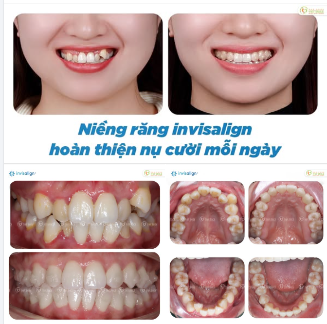 THAY DIỆN MẠO, ĐỔI TỰ TIN CÙNG INVISALIGN