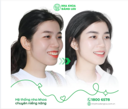 NIỀNG RĂNG KHÔNG CHỈ LÀM ĐỀU RĂNG  MÀ CÒN GÓP PHẦN KIẾN TẠO GÓC NGHIÊNG HÀI HÒA HƠN