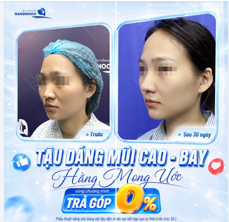 BAO NĂM MƠ ƯỚC VỀ MỘT DÁNG MŨI ĐẸP