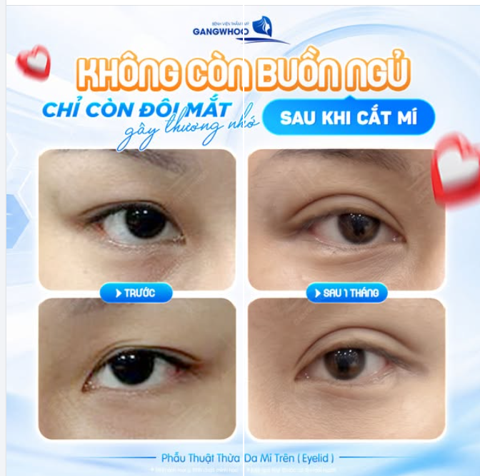 KHÔNG CÒN ĐÔI MẮT BUỒN NGỦ