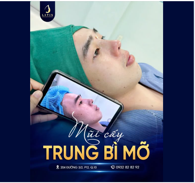 Một chiếc mũi đẹp không chỉ nằm ở độ cao của sống mũi, mà còn ở chất lượng mô mềm giúp tổng thể dáng mũi trông tự nhiên và bền vững theo thời gian.