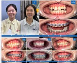 Thay đổi toàn diện dù chưa tháo niềng