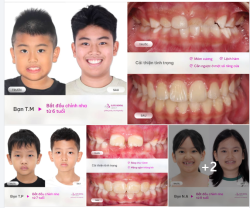 SẼ RA SAO NẾU BA MẸ NÀO CŨNG NGHĨ "ĐỢI CON THAY HẾT RĂNG RỒI MỚI CHỈNH NHA"?