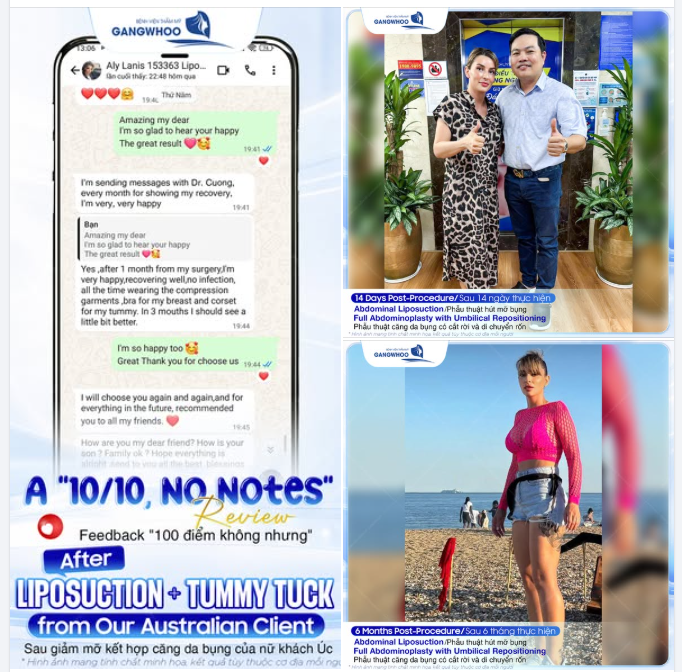 FEEDBACK "100 ĐIỂM KHÔNG NHƯNG" SAU GIẢM MỠ KẾT HỢP CĂNG DA BỤNG