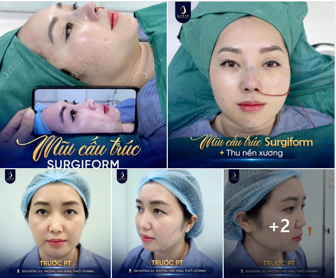 Sau khi thực hiện mũi cấu trúc Surgiform kết hợp thu nền xương:
