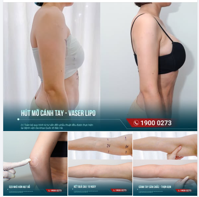 CÁNH TAY GỌN HƠN, PHẦN VAI CŨNG TRỞ NÊN THANH THOÁT HƠN