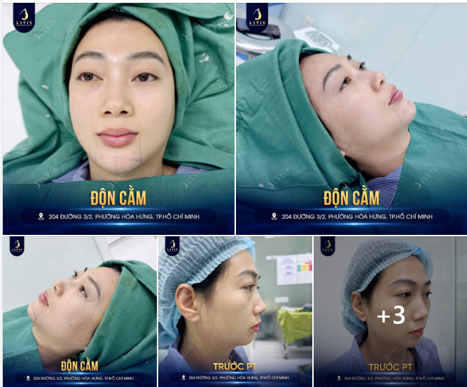 Một chiếc cằm ngắn hoặc thiếu độ nhô có thể ảnh hưởng đến tỷ lệ gương mặt.