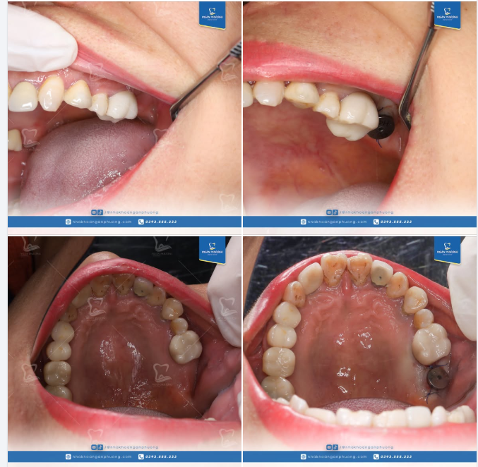 Phục hình implant răng 27 cho chị khách lâu năm