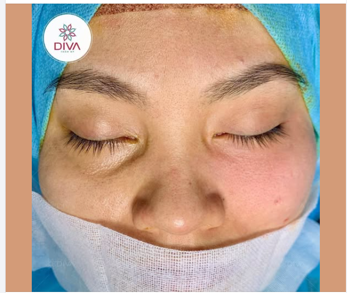 CẢI THIỆN KHUYẾT LÕM MÍ MẮT DƯỚI ĐÚNG CÁCH NHƯ THẾ NÀO?