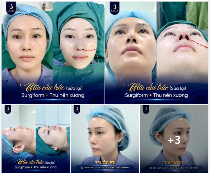 SỬA LẠI DÁNG MŨI – HOÀN THIỆN TỪNG GÓC NHÌN