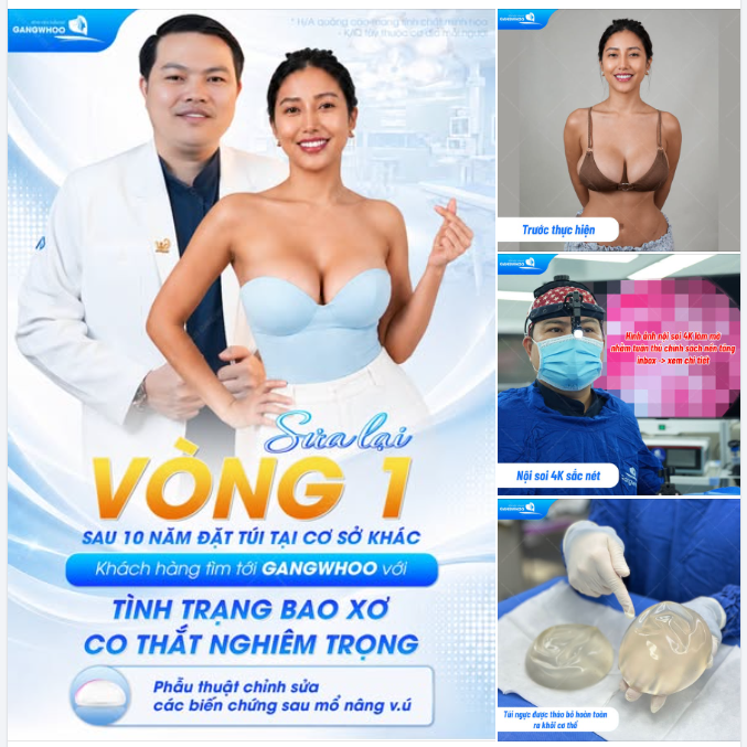 SỬA LẠI VÒNG 1 SAU 10 NĂM ĐẶT TÚI TẠI CƠ SỞ KHÁC - KHÁCH HÀNG TÌM TỚI GANGWHOO VỚI TÌNH TRẠNG BAO XƠ, CO THẮT NGHIÊM TRỌNG
