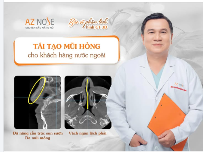 Khách hàng 9X sau 8 năm nâng mũi tại nước ngoài, mong muốn dáng mũi Sline cao vừa - đầu mũi bay nhẹ, tròn tự nhiên.