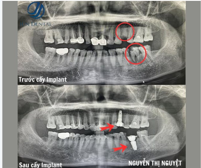 CA CẤY IMPLANT KHÁCH HÀNG NGUYỄN THỊ NGUYỆT – PHỤC HỒI RĂNG MẤT THÀNH CÔNG