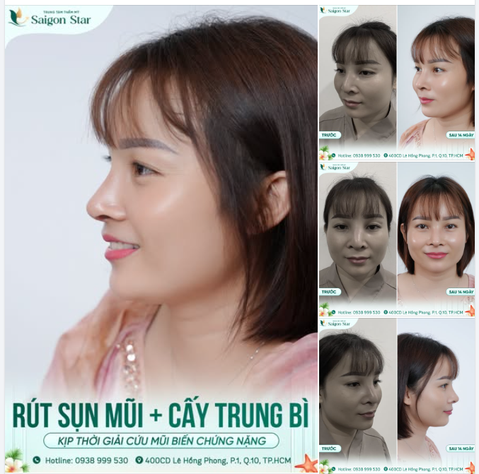 KỊP THỜI GIẢI CỨU CHIẾC MŨI ĐÃ NÂNG ĐƯỢC 7 NĂM BẤT NGỜ XUẤT HIỆN BIẾN CHỨNG NẶNG! ​