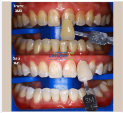 Răng vàng chẳng phải chuyện lâu,  Tẩy xong một buổi, trắng màu tự nhiên.