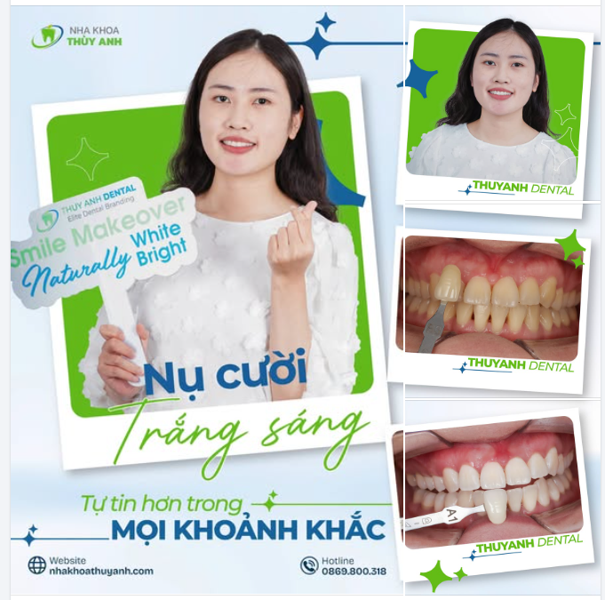 NỤ CƯỜI TRẮNG SÁNG TỰ TIN HƠN TRONG MỌI KHOẢNH KHẮC