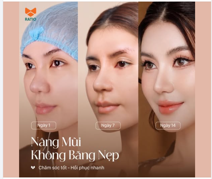 MỘT DÁNG MŨI KHÔNG ĐẸP LÊN TRONG 1 NGÀY