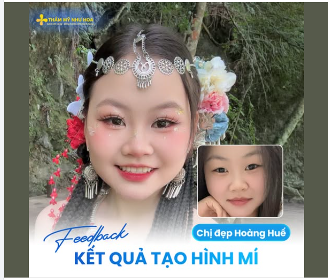 Mí s.ụp, nếp mí mờ làm đôi mắt lúc nào cũng trông mệt mỏi?