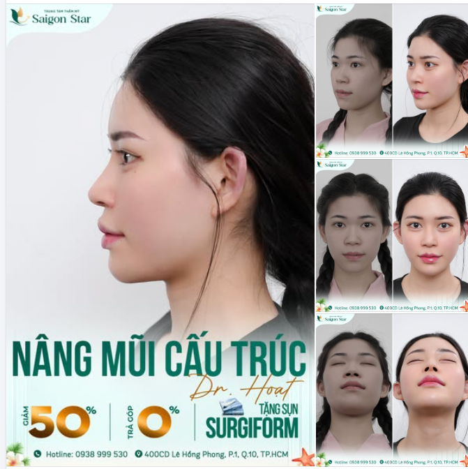 VISUAL LÊN HƯƠNG SAU 10 NGÀY NÂNG MŨI