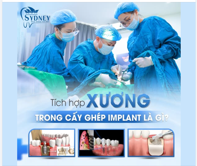 TÍCH HỢP XƯƠNG TRONG CẤY GHÉP IMPLANT LÀ GÌ?