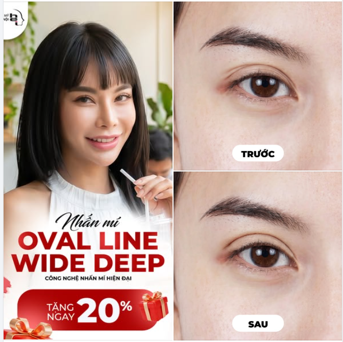 NHẤN MÍ OVAL LINE WIDE DEEP – MẮT SANG CHẢNH, QUYẾN RŨ