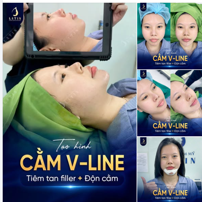 TẠO LẠI DÁNG CẰM SAU FILLER – ĐƯA TỶ LỆ GƯƠNG MẶT VỀ CÂN ĐỐI HƠN!
