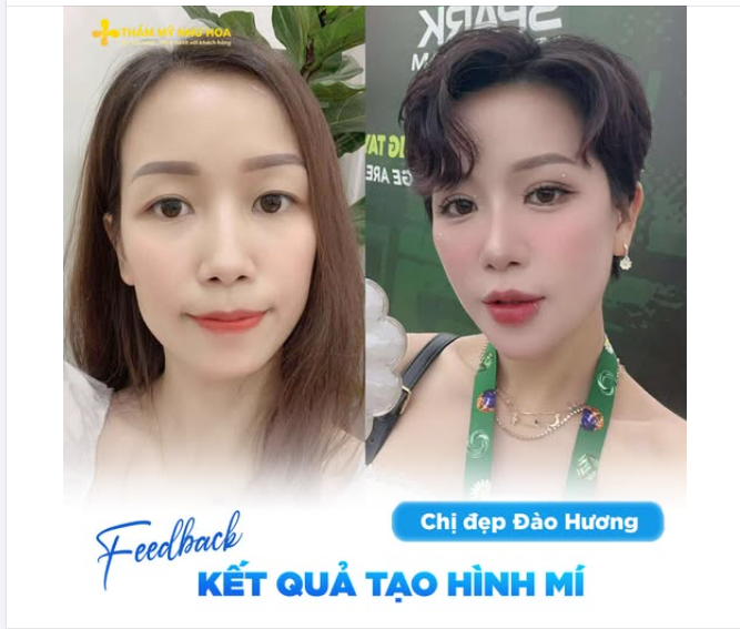 6 năm sau tạo hình mí, chị đẹp Đào Hương vẫn thường xuyên được hỏi: “Làm gì mà mắt to tròn, mí rõ và tự nhiên thế?”
