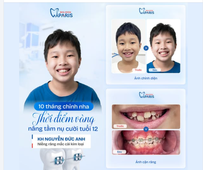 10 THÁNG CHỈNH NHA — TẬN DỤNG "THỜI ĐIỂM VÀNG" NÂNG TẦM NỤ CƯỜI TUỔI 12!