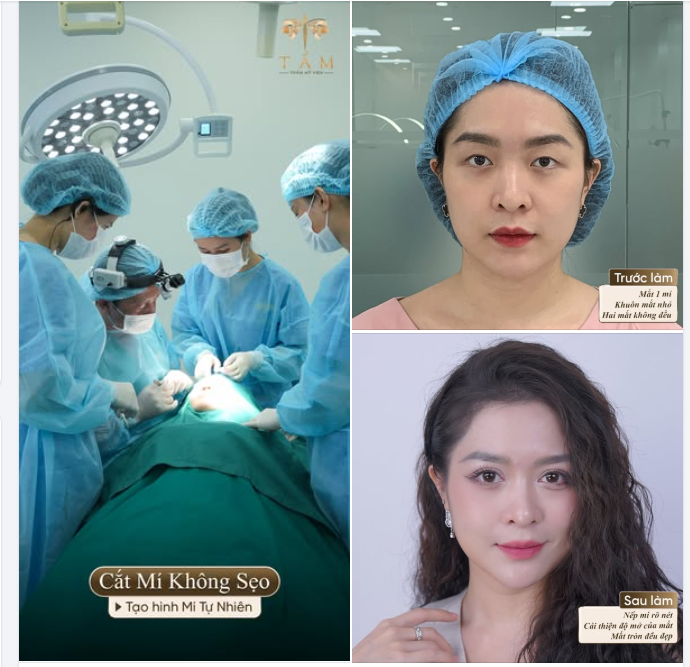 Với mong muốn 2 mí rõ đều hơn nhưng không "lộ", "giả" của chị P.T thì cắt mí không sẹo chính là lựa chọn phù hợp nhất.