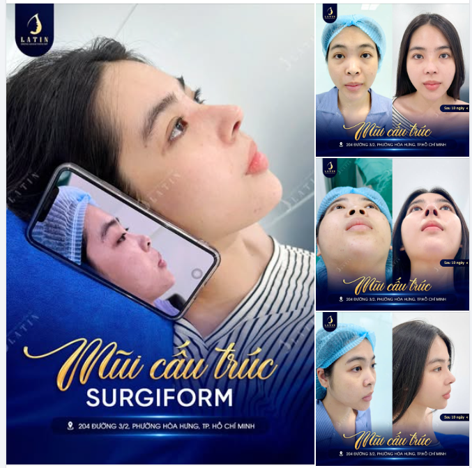 Sau 10 ngày nâng mũi cấu trúc: