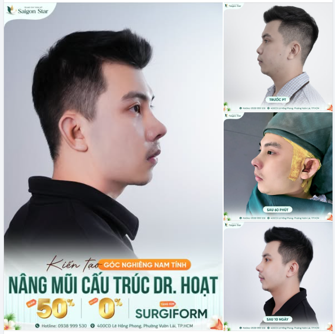 NÂNG MŨI CẤU TRÚC DR. HOẠT dư sức tạo nên một quý ông nam tính và cuốn hút!!!!
