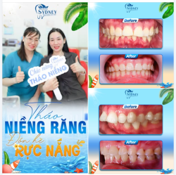 THÁO NIỀNG RĂNG - ĐÓN HÈ RỰC NẮNG