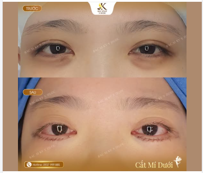 Tạm biệt quầng thâm khó trị.  Tạm biệt đôi mắt trũng, thiếu sức sống.