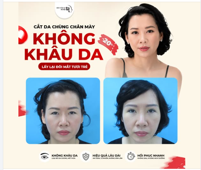 CẮT CHÙNG DA CHÂN MÀY - LẤY LẠI ĐÔI MẮT TƯƠI TRẺ