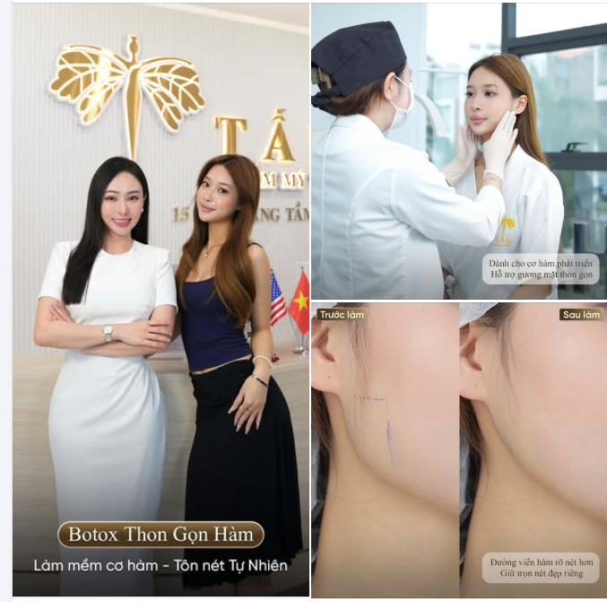 Botox thon gọn hàm với các tiêu chí:  Hạn chế xâm lấn  Không thời gian nghỉ dưỡng  Không để lại dấu vết thẩm mỹ