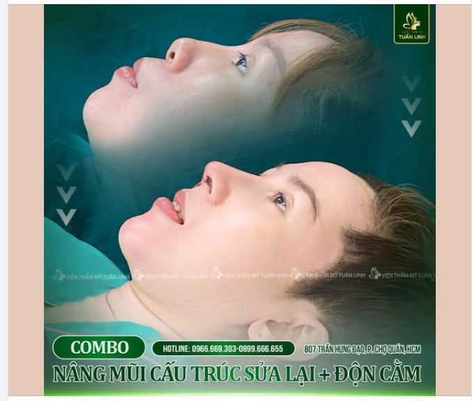 NÂNG MŨI SỬA LẠI + ĐỘN CẰM – "L.ỘT XÁ.C" DIỆN MẠO CHỈ SAU MỘT LẦN THỰC HIỆN !!