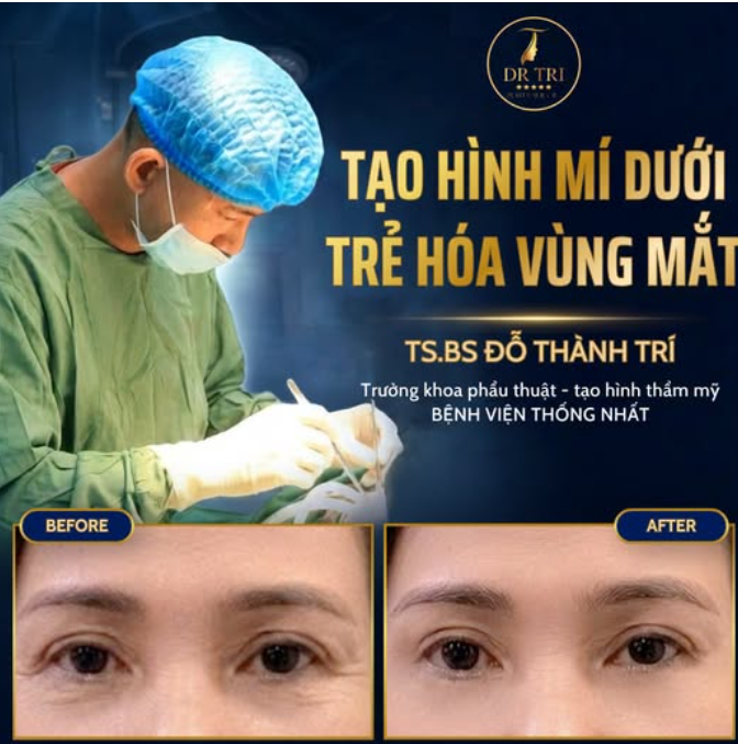 CHỈ 30' TẠM BIỆT BỌNG MẮT MỠ THỪA - CHÀO ĐÓN ĐÔI MẮT TRẺ TRUNG