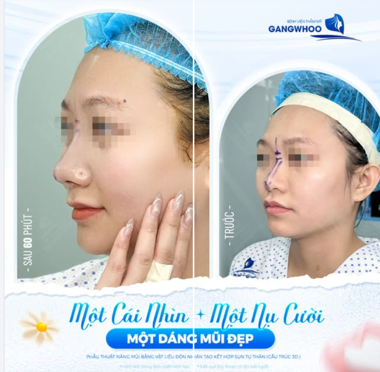 MỘT CÁI NHÌN - MỘT NỤ CƯỜI - MỘT DÁNG MŨI ĐẸP