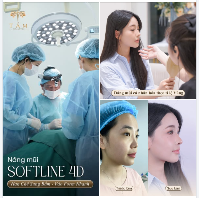 Nâng mũi Softline 4D với dáng mũi cao bay tự nhiên, không đơ cứng, tạo nên đường cong mềm mại .