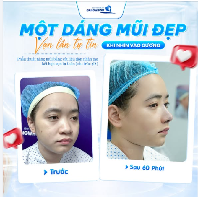 MỘT DÁNG MŨI ĐẸP - VẠN LẦN TỰ TIN