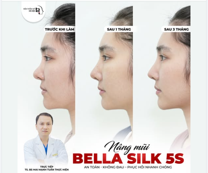 NÂNG MŨI BELLA SILK 5S - ĐẸP MÀ KHÔNG ĐAU, TẠI SAO KHÔNG?