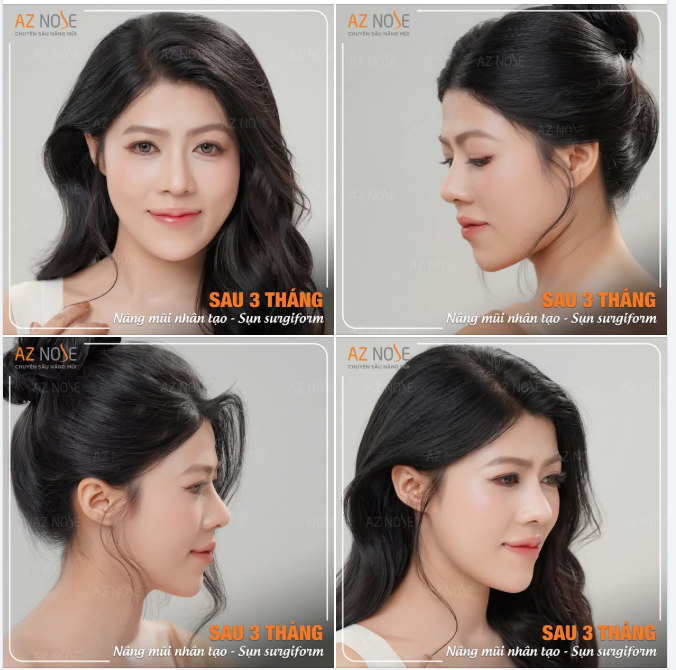 Dáng mũi hài hòa sau 3 tháng nâng mũi nhân tạo - sụn Surgiform